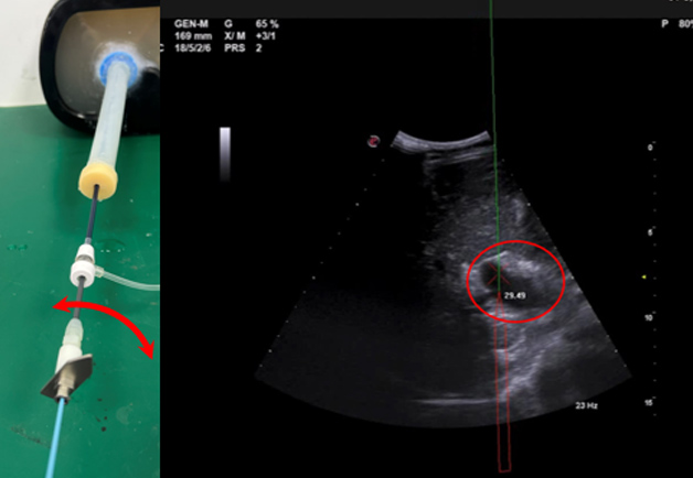 經(jīng)頸靜脈肝內(nèi)門體分流術(shù)（transjugular intrahepatic portosystemic shunt）